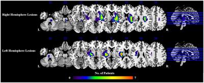 Alterations of dynamic and static brain functional activities and integration in stroke patients